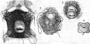 Как называется операция зашивания шейки матки