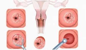 Конизация шейки матки стоимость в онкологии донецкой области