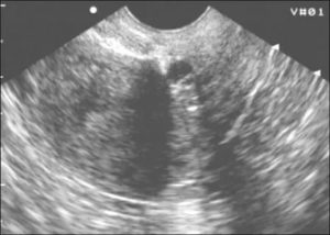 Эндометриоз послеоперационного рубца тела матки