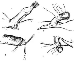 Какие последствия могут быть после операции на фимоз