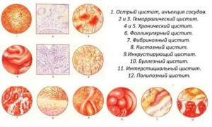 Почему не проходит острый цистит