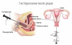 Сколько идут месячные после чистки гиперплазии эндометрия