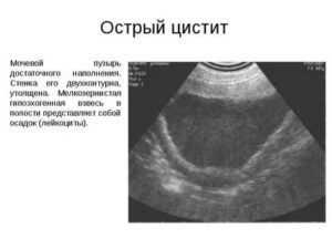 Что может показать узи мочевого пузыря и почек при цистите