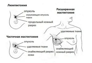 Почему болят грудные железы когда была операция при удалении матки