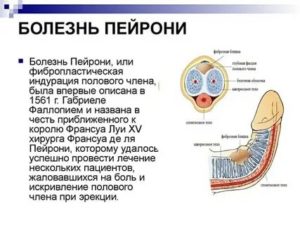 Как вылечить болезнь пейрони без операции