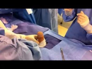 Сколько будет стоить операция на фимоз