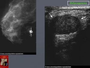 Как отличить на узи кисту от фиброаденомы молочной железы
