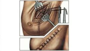 Когда снимают дренаж после операции на молочной железе