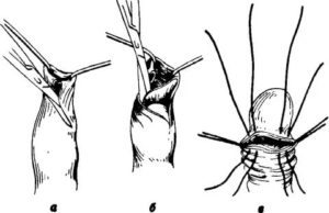 Как сделать перевязку после операции рубцового фимоза у детей