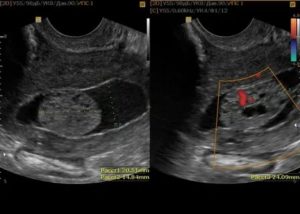 Уплотнение эндометрия матки на узи что это такое