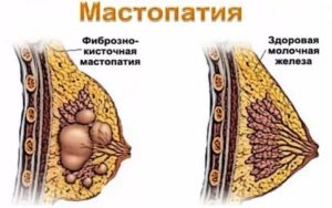 Мастопатия при климаксе симптомы и лечение отзывы