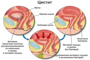 Как отличить цистит от венерологических болезней