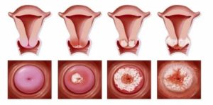 Что такое предраковая опухоль шейки матки