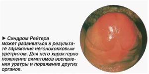 Покраснение и опухоль уретры