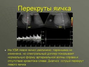 Может ли быть перекрут яичка если уже была такая операция