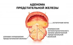 Лечение чагой аденомы предстательной железы