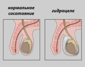 Почему держится температура после операции гидроцеле
