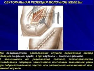 Секторальная резекция молочной железы при раке отзывы пациенток