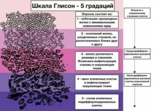 Низкодифференцированный рак предстательной железы прогноз