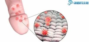 Белый налет на головке члена после антибиотиков