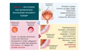 Как восстановить слизистую мочевого пузыря при хроническом цистите