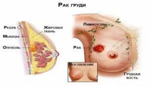 Как определить опухоль молочной железы на ощупь