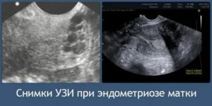 Когда лучше делать узи при подозрении на эндометриоз