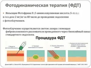 Фотодинамическая терапия при лечении рака шейки матки