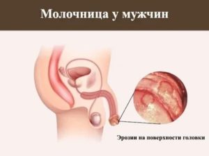 Покраснение головки из-за хронического простатита