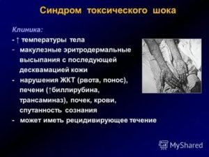 Что такое менструальный синдром токсического шока