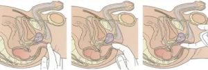 Как правильно делать массаж простаты и сколько по времени