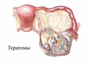 Как беременность влияет на опухоль яичников