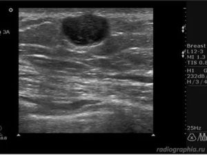На узи гипоэхогенное образование молочной железы что это такое