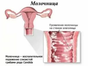 Если при молочнице расчесать