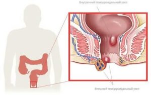 Может ли геморрой спровоцировать цистит