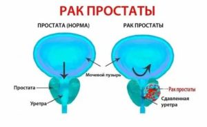 Тодикамп при лечении рака простаты