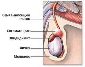 Когда рак яичек в армию берут