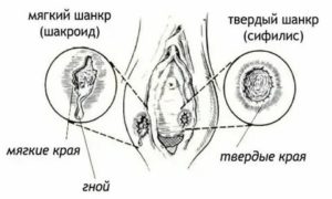 Как выглядит мягкий шанкр у женщин