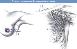 Лимфаденэктомия при раке молочной железы