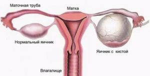 Можно ли заниматься интимной жизнью при кисте яичника