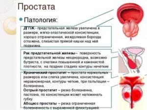 Причины отсутствия спермы при лечении простатита