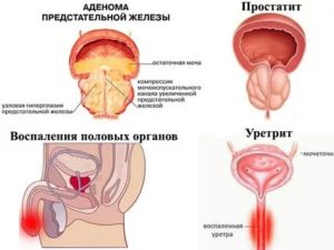В чем различие между простатитом и аденомой