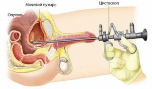 Уретроскопия и цистоскопия при простатите