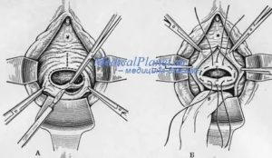 Как делают операцию по пузырно-влагалищный свищ