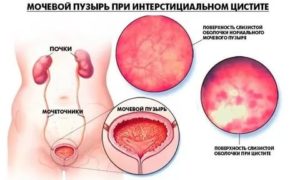 Что такое гнойный цистит и как его лечить