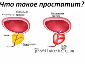 Можно ли пить кофе при простатите и аденоме простаты