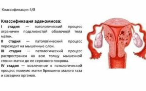 Эхоскопические признаки эндометриоза тела матки что это такое