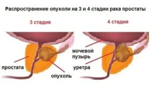 Рак простаты у мужчин симптомы лечение 3 степени что нужно сделать чтобы