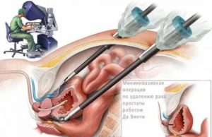 Как влияет операция по удалению аденомы простаты на потенцию