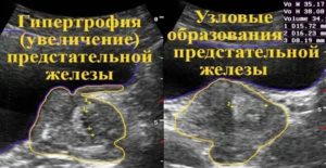 Точные методы исследования предстательной железы